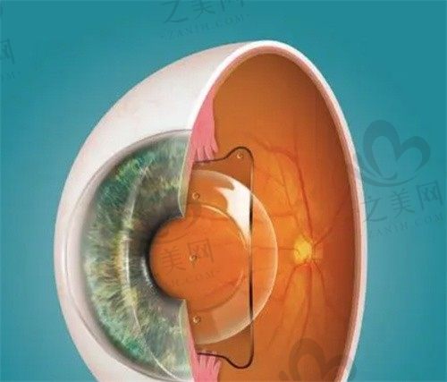    长春市恒达眼科医院彭秀芹白内障手术超声乳化+人工晶体植入8000元起，效果不错