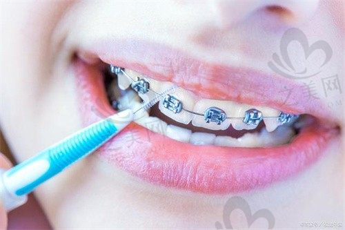   绍兴京韩口腔医院温朋兵儿童早期矫治5000元起，价格透明效果好