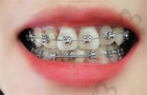 威海金沙口腔门诊部肖秀敏时代天使隐形矫正9999元，隐形矫正成果非常好