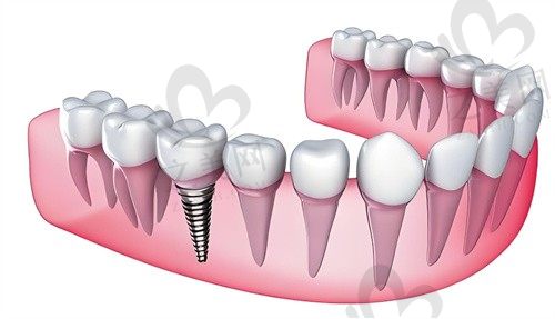 丽水青田口腔医院甄培军医生HT-德国先锋种植体3980元，安好舒适微创种植牙 