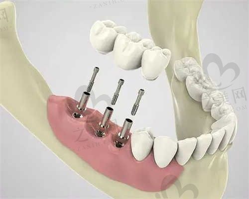 常德桃源金口口腔医院何浩然医生种植牙2980元/颗，还带全瓷冠，从患者的种牙分享来看很不错