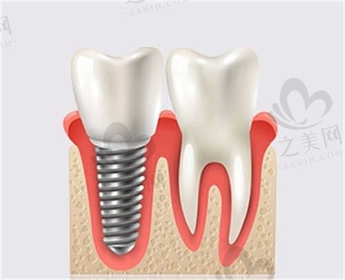 南充大众口腔诊所怎么样？种植牙技术不错，价格透明，口碑爆棚！