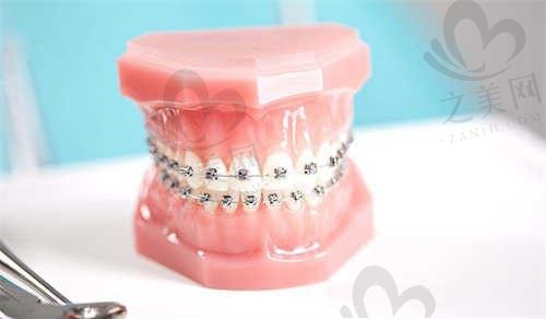 佛山领雅口腔门诊部涂锦锦医生金属自锁5800元起，简单、中等、复杂等矫正价格都在这