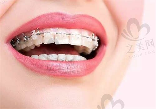 吉林市臻美口腔门诊部宁继威医生牙齿矫正9600元起，从患者的分享来看矫正结果真不错