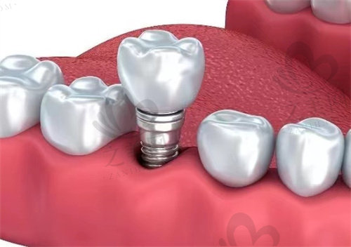 湖州安吉复大中齿口腔医院种植牙多少钱