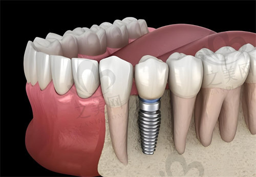 关于种植牙的常见问题解答
