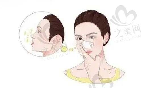 李鸿君医生修复鼻子怎么样了？很不错，技术好手法娴熟。