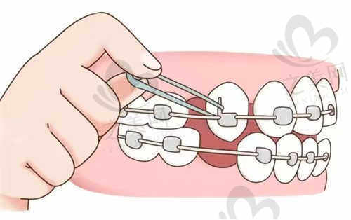 奥雅口腔特色技术：激光牙周治疗