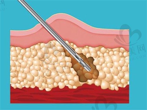 广州荔湾区人民医院整形美容科取出注射隆胸物价格是多少？详解手术费用及报销政策