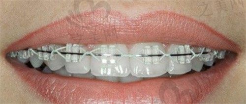   桂林美皓口腔门诊部周琳儿童金属托槽矫正3800元起，价格透明服务周到