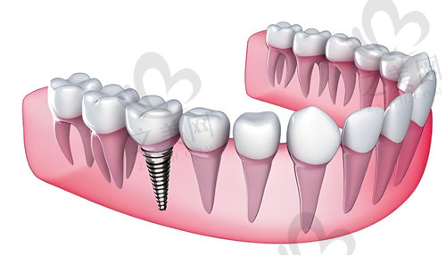 北京中诺口腔医院特色种植牙怎么样