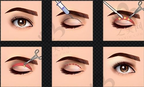 广州荔湾区人民医院整形美容科双眼皮多少钱？价格/技术详解，安全可靠