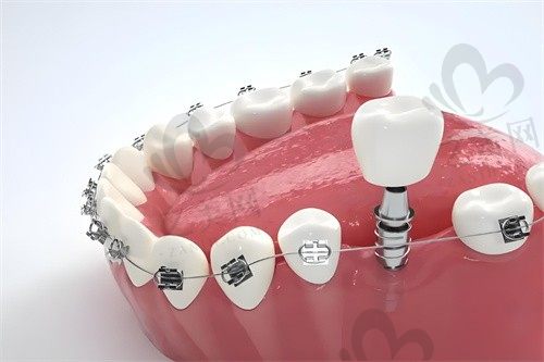 北京中诺口腔医院牙齿矫正价格是多少?不同矫正方式费用对比,矫正效果令人满意