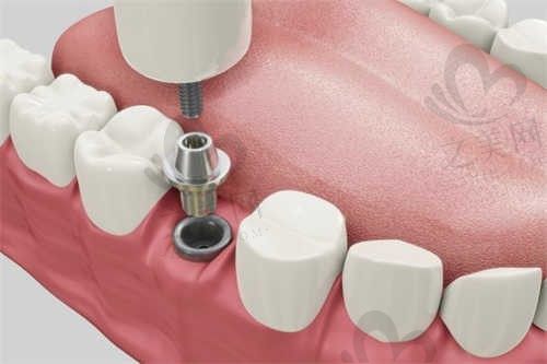 安徽亳州康桥口腔门诊部张永医生种植牙1500元起，特价种植牙价格这么低质量怎么样？