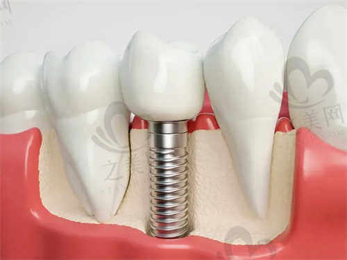 泉州海丝口腔医院推荐种植体及价格