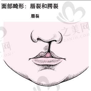 私立医院做唇腭裂手术多少钱?覆盖基础修复到复杂修复的全费用区间附推荐医院列表