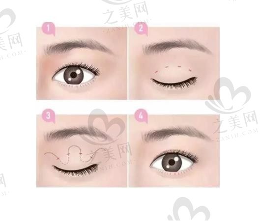 杜圆圆修复双眼皮水平怎么样?独创三维立体修复技术，20年经验重塑自然灵动美眼