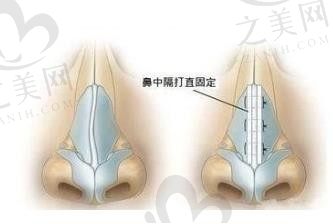 成都做隆鼻修复手术哪家医院好?成都大象致颜(鼻子专科)医疗美容/成都美丽田园靠谱口碑好。