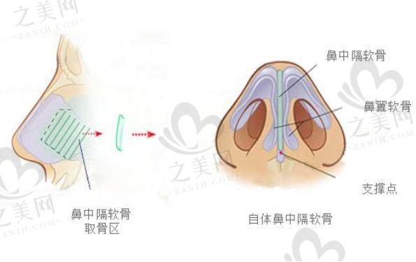 软骨垫鼻尖.jpg