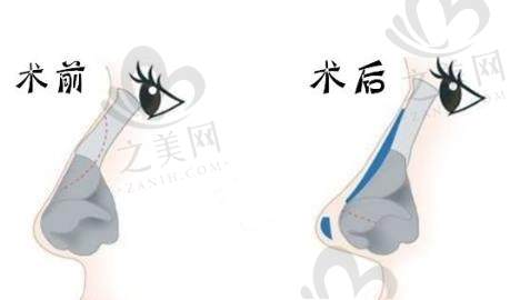 鹰钩鼻矫正.jpg