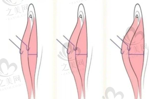 私密整形包括哪些项目?手术/注射/激光等哪家医院较好/大概多少费用