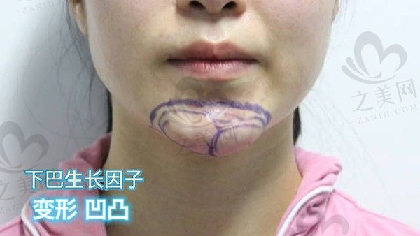 黄罡医生取异物怎么样?北京面部异物取出专家排名前几,生长因子/奥美定清除干净不留痕,修复自然!