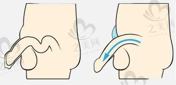男士假体植入手术
