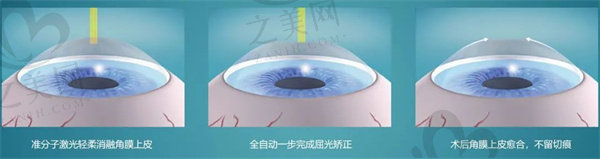杭州明视康眼科医院近视价目表