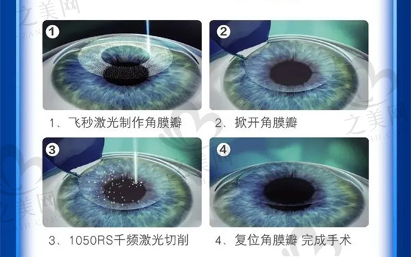 杭州明视康眼科医院近视价目表