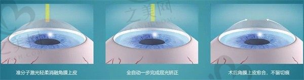 杭州明视康眼科医院近视价目表,全飞秒18000元微创无瓣,半飞秒12000元精准