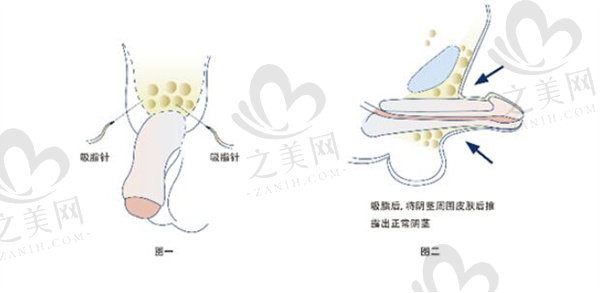安阳做生殖增粗哪个医院好