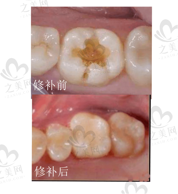 从自身补牙经历,来看用3m玻璃离好还是用树脂好?