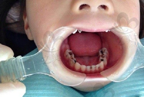 孩子乳牙长虫牙可以不用管吗?是不是换了牙就能好呢?