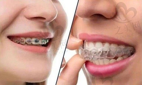 儿童牙齿矫正用金属牙套还是隐形好,选择适合的托槽很重要