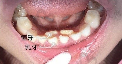 小孩子为什么会出现双排牙,出现双排牙该怎么办呢?