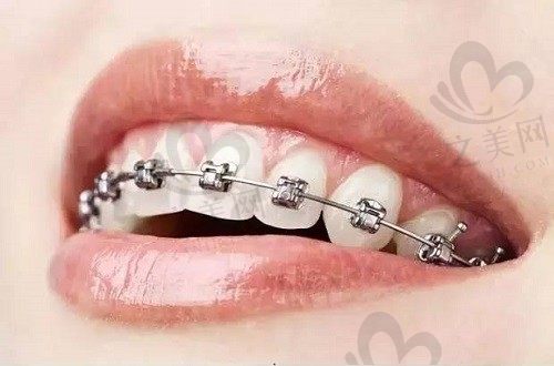 牙齿矫正期间怀孕了怎么办?没想到怀孕对矫正还有这个好处