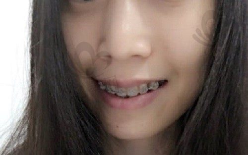 牙齿矫正疼不疼呀,正畸过程中的疼痛要怎么缓解呢?