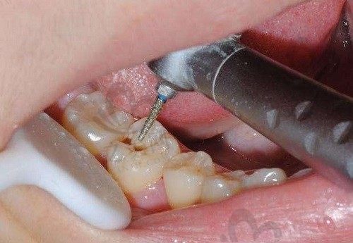 补牙疼不疼,用打麻药吗?补牙的流程及步骤是什么的