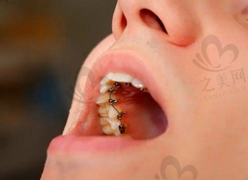 舌侧矫正是什么意思?相比隐形矫正有哪些优势呢