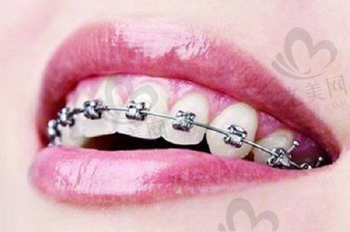 牙齿矫正时间取决于什么?是不是矫正时间越快越好呢