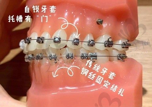自锁托槽和非自锁托槽的区别有哪些?自锁托槽的优势是什么