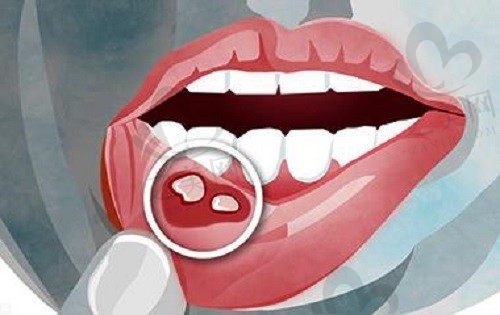 牙齿矫正期出现口腔溃疡是怎么回事,要怎么缓解呢?