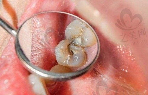 为什么要补牙呢?出现哪些情况需要补牙