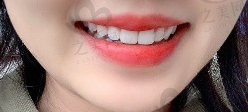 牙齿贴面能保持多久 会不会影响吃饭呢?为何如此受大家追捧