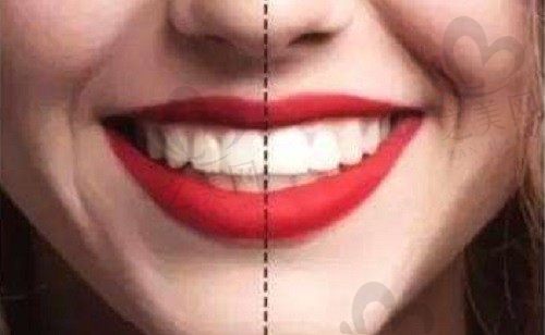 牙齿矫正大概要花费多少钱?多大年龄矫正合适呢