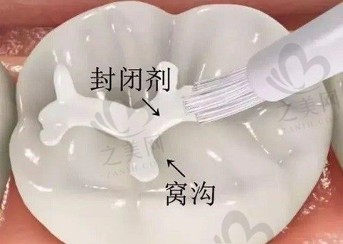 为什么要做窝沟封闭,窝沟封闭的好处有哪些?
