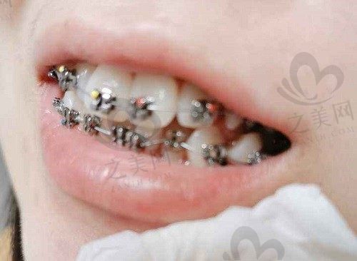 牙齿不齐主要表现在哪些方面?这几点你需要了解