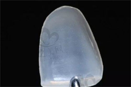 牙齿贴面修复是什么意思?牙齿贴面有几种材料?