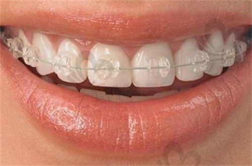 牙齿矫正多大年龄比较好?牙齿矫正大概要花费多少钱?