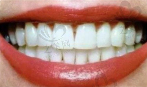 冷光美白牙齿对牙齿有什么伤害?做牙齿冷光美白痛不痛呀